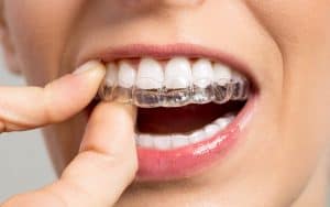 ataches invisalign